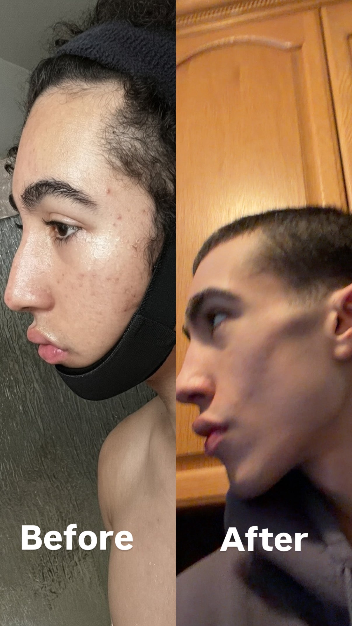 Ferrer Chin Strap (60 Days To a More Defined Jaw)