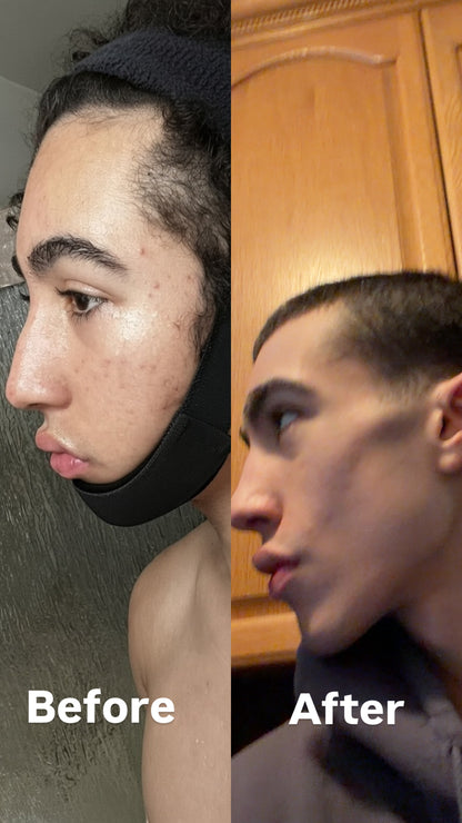 Ferrer Chin Strap (60 Days To a More Defined Jaw)